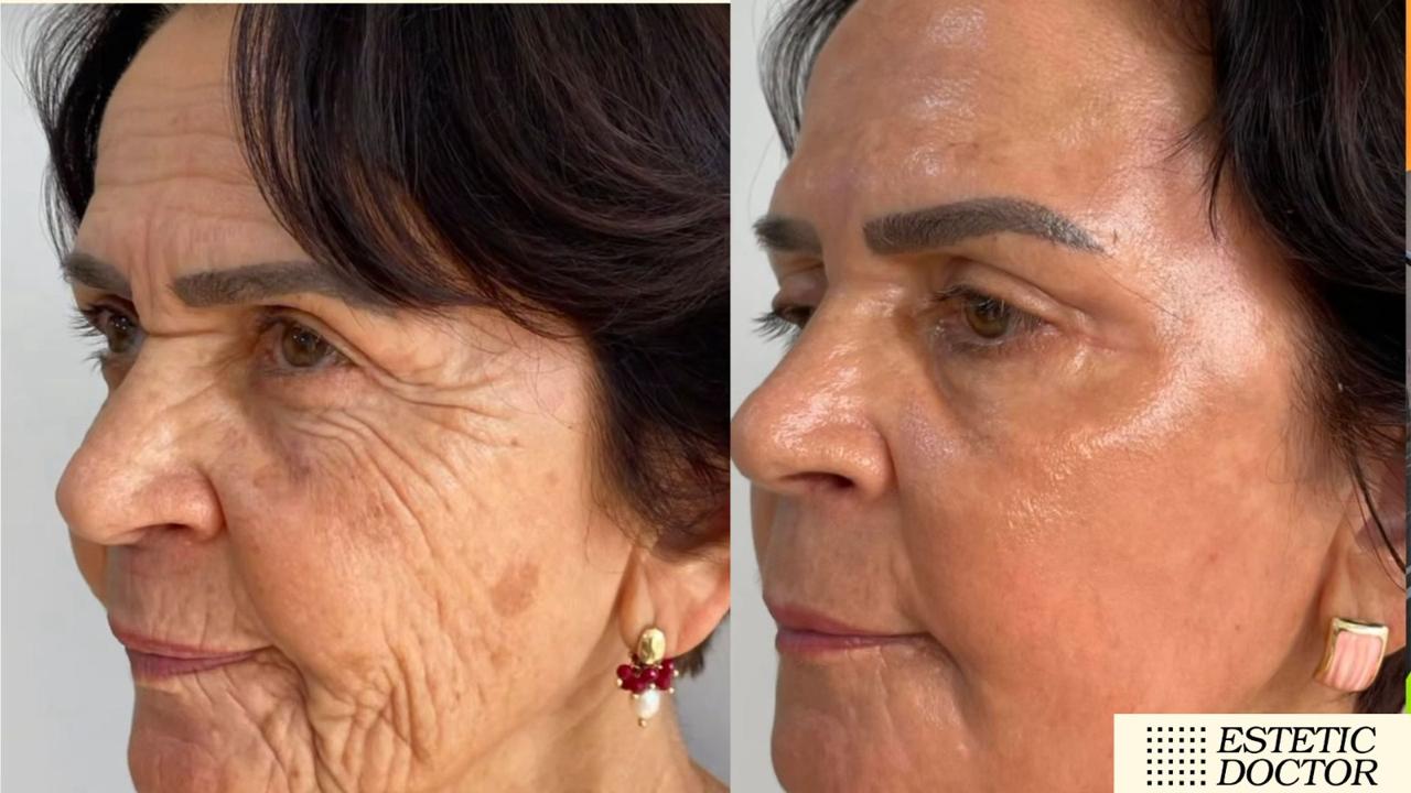 Regeneração Full Face